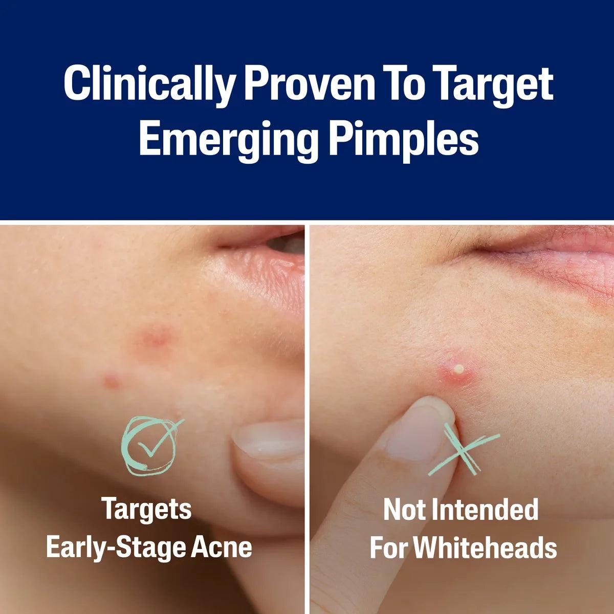 Cetaphil Acne Spot Pimple Patches with Salicylic Acid - 24ct: For Face, Oily to Dry Skin, Sensitive, Mature, Acne-Prone
