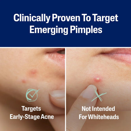 Cetaphil Acne Spot Pimple Patches with Salicylic Acid - 24ct: For Face, Oily to Dry Skin, Sensitive, Mature, Acne-Prone